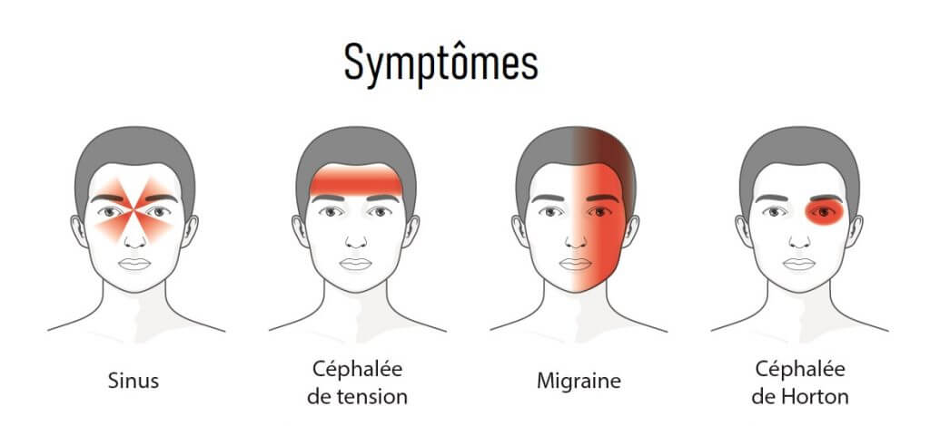 symptômes de migraine clinique physio St-Hubert